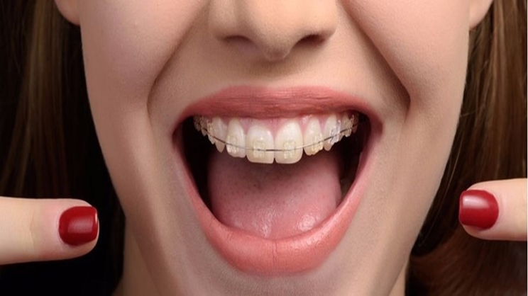 Diş Teli Tedavisi Nasıl Yapılmalıdır?