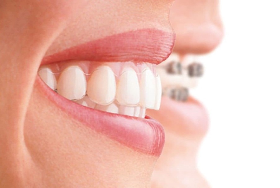 Diş Teli Türleri Nelerdir?