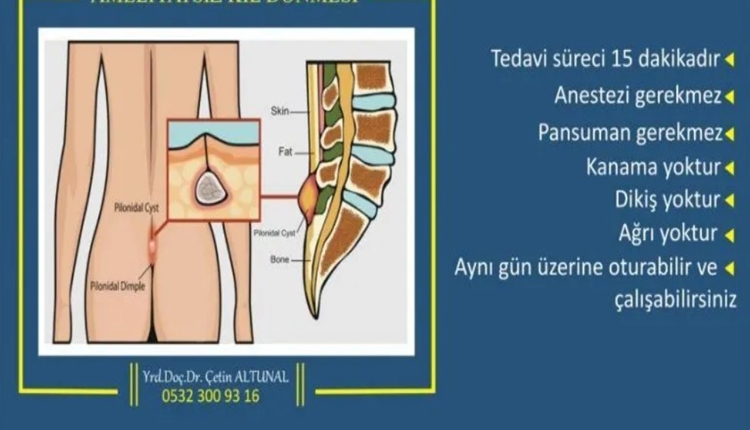 Kıl Dönmesi